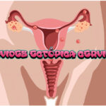 Gravidez ectópica cervical