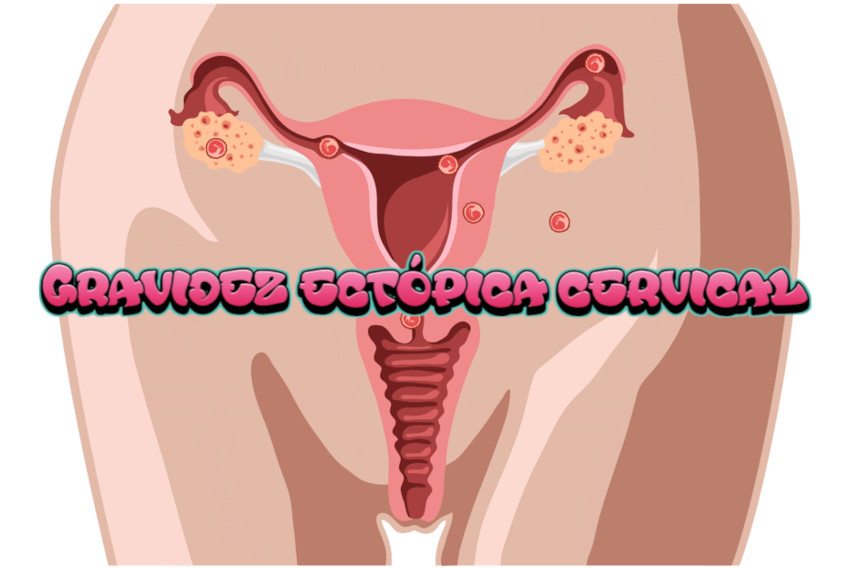 Gravidez ectópica cervical