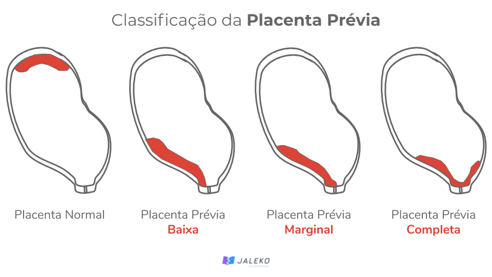 Placenta Prévia