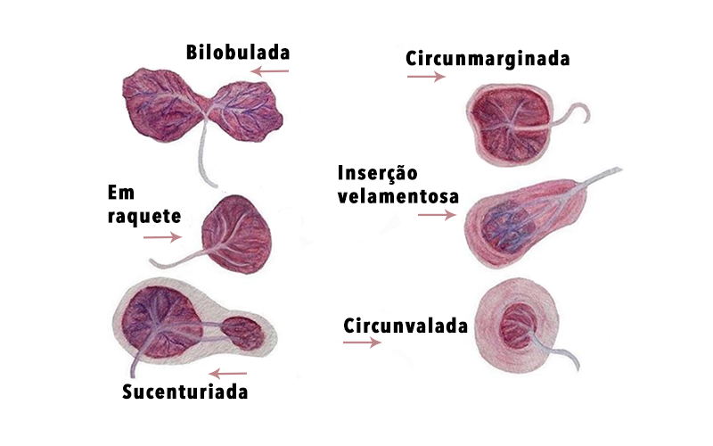Placenta Sucenturiada