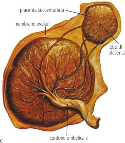 Placenta sucenturiada