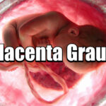 Placenta Grau 1 pode ter parto normal?